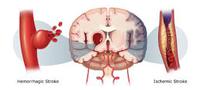 obat stroke denature